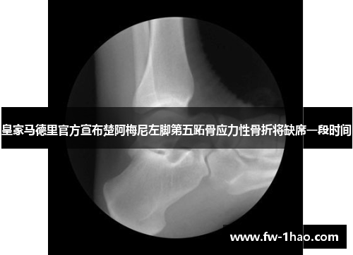 皇家马德里官方宣布楚阿梅尼左脚第五跖骨应力性骨折将缺席一段时间